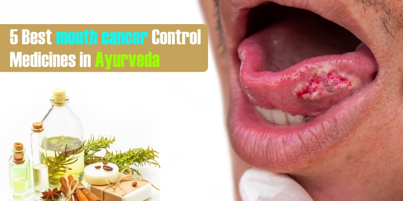 5 Best Mouth Cancer Control Medicines in Ayurveda